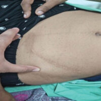 Figure 1: Pre-operative examination showing a previously healed surgical mark.