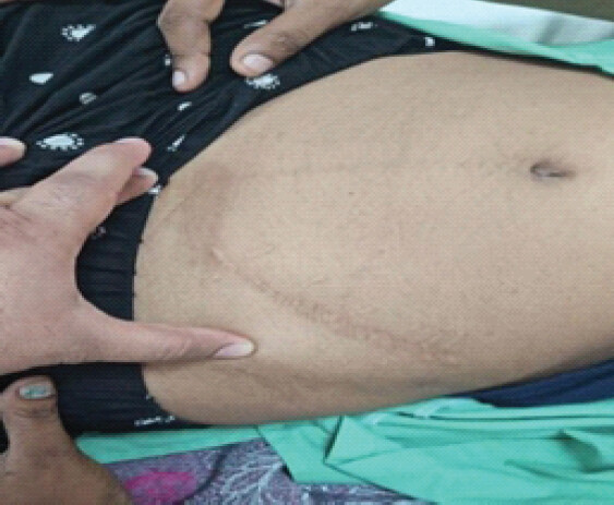 Figure 1: Pre-operative examination showing a previously healed surgical mark.