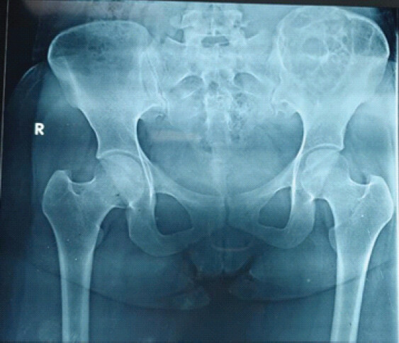 Figure 2: Plain radiography demonstrated osteolytic lesions involving the left iliac wing with extension into a portion of the sacrum.