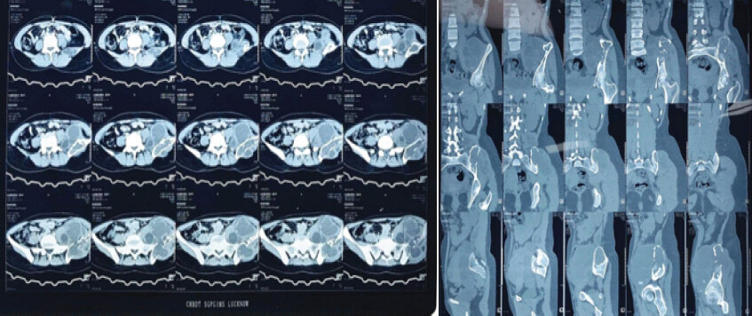 Figure 3: (a) Patient’s computed tomography (CT) pelvis showing involvement of lesion in the left iliac bone, surrounding multiloculated lesion involving the iliopsoas and gluteus medius muscles. (b) Patient’s CT pelvis coronal section showing involvement of the lesion in the left iliac bone.