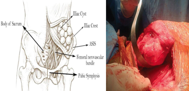 Figure 4: Schematic diagram (artificial intelligence generated) showing extensive involvement of the ilium and intra-operative image showing the cyst protruding from the ilium.