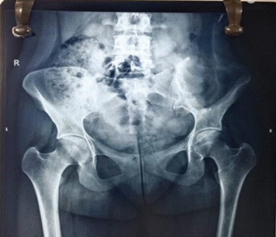 Figure 5: Post-operative X-ray of the pelvis with both hips showing type I hemipelvectomy.