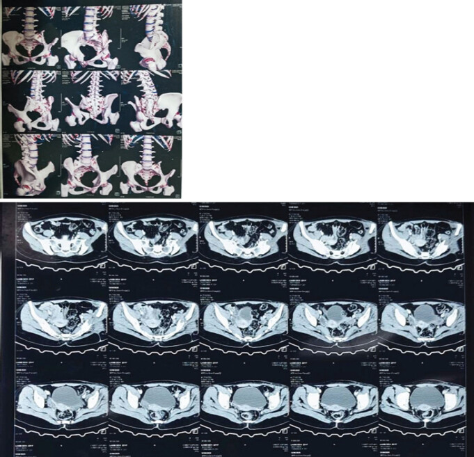 Figure 6: ?Post-operative 3D computed tomography pelvis.
