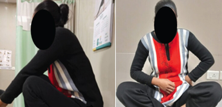 Figure 7: (a and b) Post-operative 3 months, patient able to squat and sit with crossed leg comfortably.
