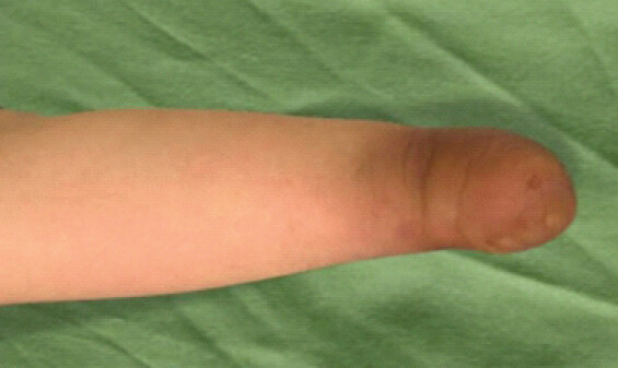 Figure 2: Clinical photograph of the left upper extremity in transverse profile, demonstrating the rounded terminal soft-tissue envelope and rudimentary distal nubbins.