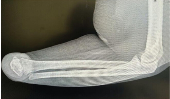 Figure 4: Lateral radiograph of the left forearm demonstrating the hypoplastic distal radius and ulna and an irregular dysplastic ossified structure within the terminal soft-tissue envelope, representing a rudimentary distal osseous anlage.