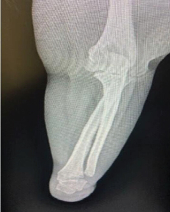 Figure 5: Anteroposterior radiograph of the left forearm demonstrating the terminal transverse deficiency, hypoplastic distal radius and ulna, rudimentary distal osseous anlage, and absence of normally formed metacarpal and phalangeal elements.