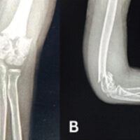 Figure 1: Immediate post-traumatic X-rays of right elbow (a) anteroposterior view, (b) lateral view.
