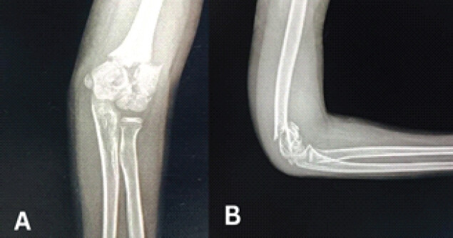 Figure 1: Immediate post-traumatic X-rays of right elbow (a) anteroposterior view, (b) lateral view.