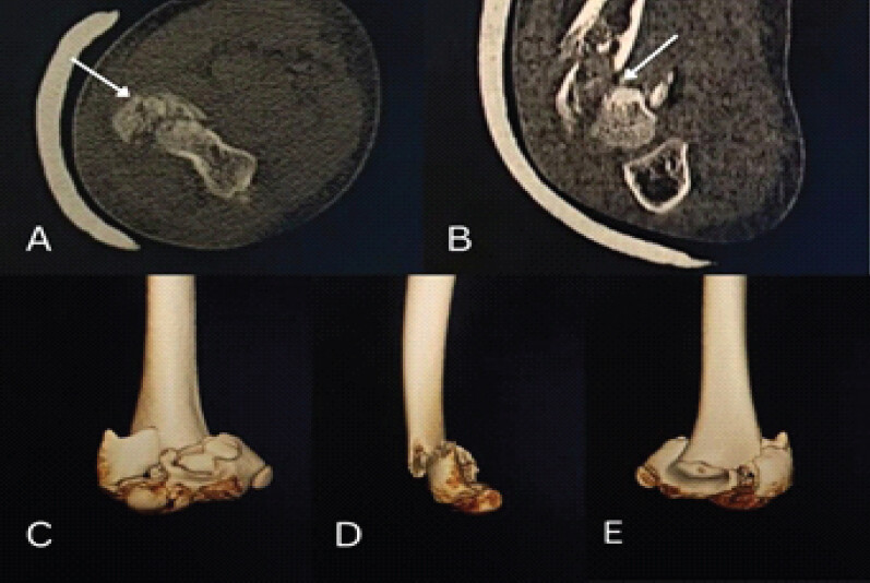 Figure 2: Pre-operative computed tomography (CT) images of right elbow. (a) Axial (b) sagittal view with white arrow indicating the fracture line of the T-shaped distal humerus fracture with capitulum shear fracture. (c, d, e) 3D reconstruction of the CT scan.