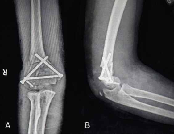 Figure 3: Immediate post-operative X-rays showing triangular construct CC screw fixation of distal humerus fracture with Herbert screw fixation of capitulum fragment. (a) Anteroposterior view, (b) lateral view.