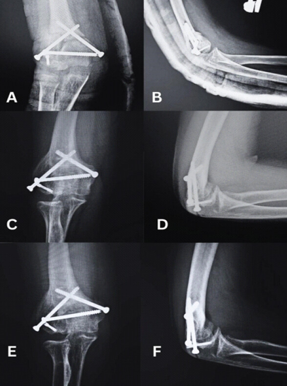 Figure 4: Post-operative follow-up X-ray images at (a and b) 1 month, (c and d) 6 months, (e and f) 12 months.