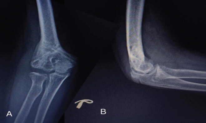 Figure 5: Post-operative follow-up X-ray images after implant removal at 1 year.