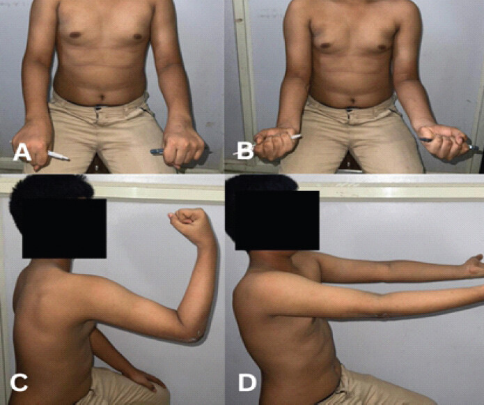Figure 6: Post-operative clinical images depicting (a) pronation, (b) supination, (c) flexion, and (d) extension at 1-year follow-up.