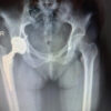 Late Diagnosis of Femoral Shaft Perforation During Total Hip Arthroplasty: Case Report