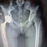 Figure 1: Anteroposterior radiograph of the femur with intramedullary located stem.