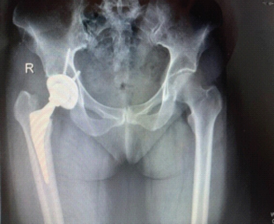 Figure 1: Anteroposterior radiograph of the femur with intramedullary located stem.