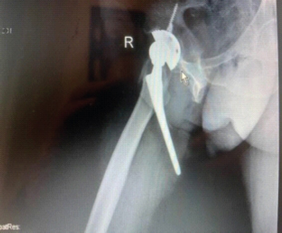 Figure 2: Lateral radiograph demonstrating posteromedial cortical perforation by the femoral stem.
