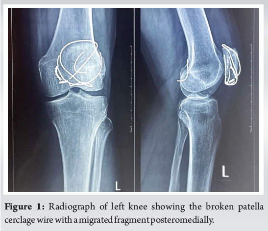 “Intra-Articular Intrusion of Broken Patella Cerclage Wire and the ...