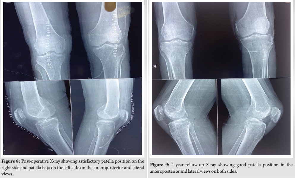 Atraumatic Bilateral Patellar Tendon Rupture: A Case Report | Journal ...