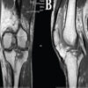Conservative Management of a Complex Schatzker Type V Bicondylar Tibial Plateau Fracture: A Case Report with 2-Year Follow-Up