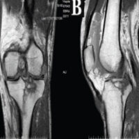 Figure 1: Coronal (a) and sagittal (b) magnetic resonance imaging images of the left knee obtained 1 week after the injury, showing a comminuted fracture of the lateral and medial tibial plateau.
