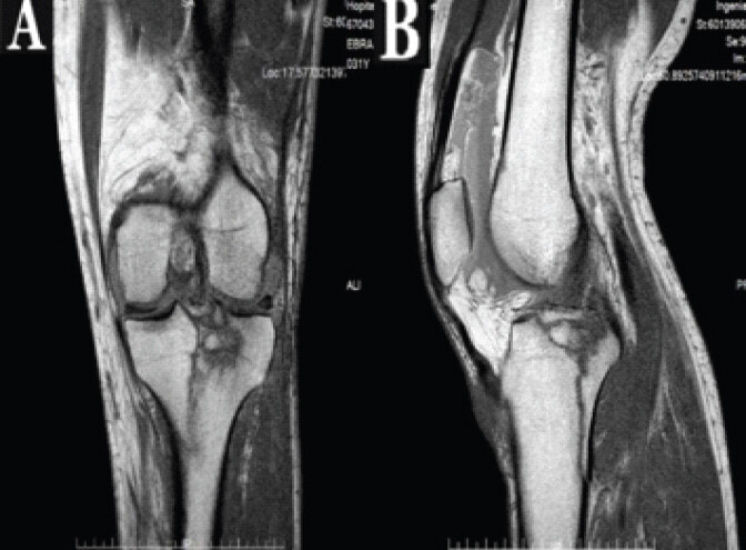 Figure 1: Coronal (a) and sagittal (b) magnetic resonance imaging images of the left knee obtained 1 week after the injury, showing a comminuted fracture of the lateral and medial tibial plateau.