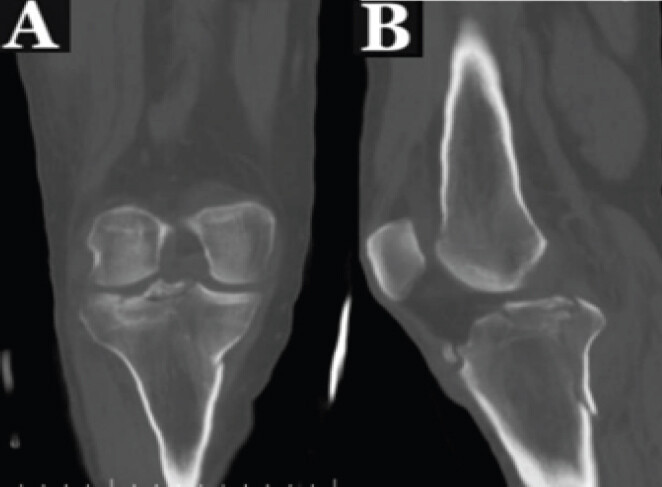 Figure 2: Coronal (a) and sagittal (b) views of a computed tomography scan done a 2 weeks after the fracture.