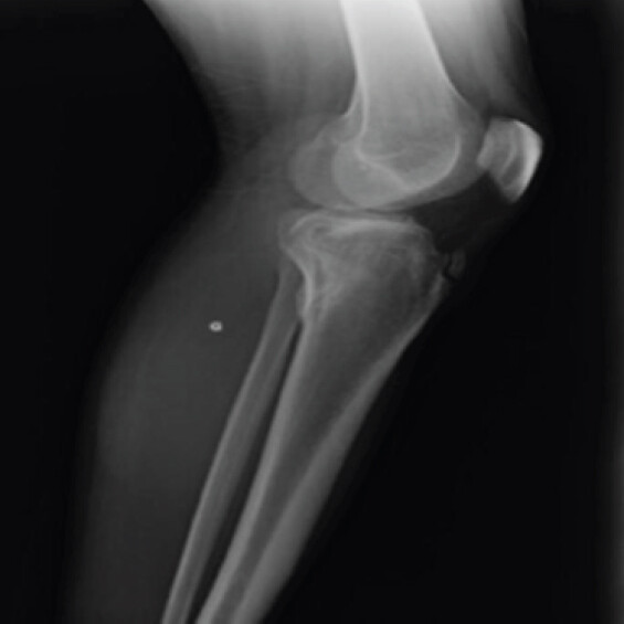 Figure 3: Lateral radiograph of the left knee obtained 4 months after the fracture, showing fracture consolidation.