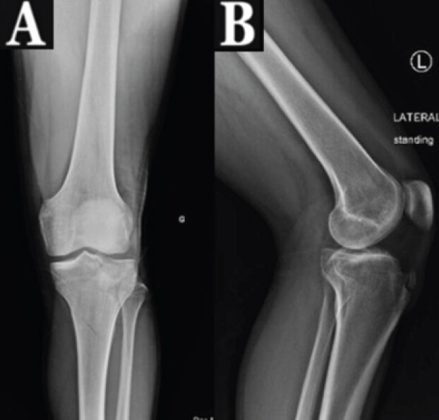 Figure 4: Anteroposterior (a) and lateral (b) radiographs of the left knee obtained 2 years after the fracture, showing complete fracture healing with maintained alignment.