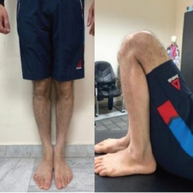 Figure 5: Clinical photographs obtained at the 2-year follow-up demonstrating knee extension and flexion.