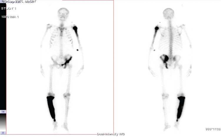 Figure 1: Bone scan images. Tissue phase images reveal increased tracer distribution in the proximal part of the left humerus, left hemipelvis, and proximal two-thirds of the right tibia. It is notable that there was no uptake in the kidneys, consistent with chronic kidney disease.