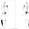 Role of Denosumab in Chronic Kidney Disease with Paget’s Disease of Bone: A Case Report and Review of Literature