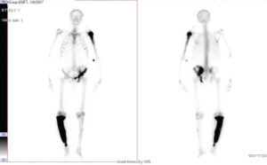 Figure 1: Bone scan images. Tissue phase images reveal increased tracer distribution in the proximal part of the left humerus, left hemipelvis, and proximal two-thirds of the right tibia. It is notable that there was no uptake in the kidneys, consistent with chronic kidney disease.