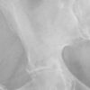 Real-Time Coagulation Monitoring via Thromboelastography and Platelet Mapping in Total Hip Arthroplasty for a Patient with Factor XI Deficiency: A Case Report
