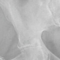 Figure 1: Pre-operative anteroposterior radiograph of the pelvis demonstrating advanced right hip joint degeneration, subchondral sclerosis, and joint space narrowing consistent with severe osteoarthritis.