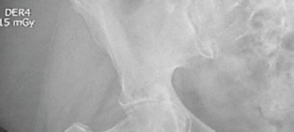 Figure 1: Pre-operative anteroposterior radiograph of the pelvis demonstrating advanced right hip joint degeneration, subchondral sclerosis, and joint space narrowing consistent with severe osteoarthritis.