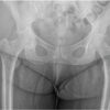 Real-Time Coagulation Monitoring via Thromboelastography and Platelet Mapping in Total Hip Arthroplasty for a Patient with Factor XI Deficiency: A Case Report