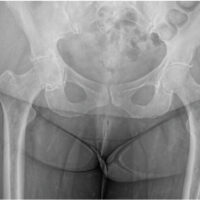 Figure 1: Pre-operative anteroposterior radiograph of the pelvis demonstrating advanced right hip joint degeneration, subchondral sclerosis, and joint space narrowing consistent with severe osteoarthritis.