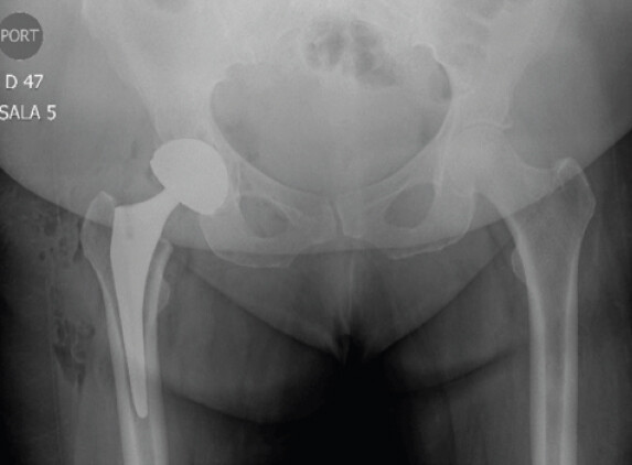 Figure 3: Post-operative anteroposterior pelvic radiograph confirming optimal placement, alignment, and stability of the non-cemented stem and press-fit acetabular prosthesis.