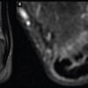 Combined Endoscopic SpeedBridge™ Reinsertion and Proximal Medial Gastrocnemius Lengthening for Chronic Insertional Achilles Tendinopathy in an Elite Sprinter: A Case Report