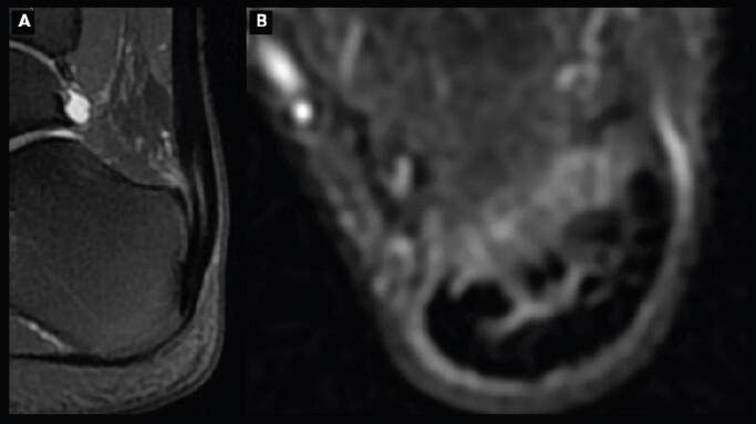 Figure 2: Pre-operative magnetic resonance imaging of the right ankle. (a) Sagittal and (b) axial T2-weighted fat-suppressed (T2 Fat-Sat) images demonstrating insertional Achilles tendinopathy with increased intratendinous signal intensity, without major retrocalcaneal bursitis or bone-marrow edema.