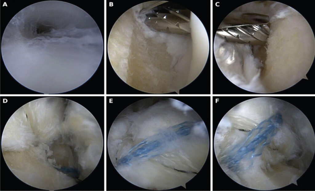 Figure 3: Intra-operative endoscopic views of the right calcaneal SpeedBridge. (a) Posterior working space; (b and c) Calcaneoplasty of the posterosuperior calcaneal corner and debridement with the burr/shaver; (d) Calcaneal tendon insertion after debridement of intratendinous calcification; (e and f) FiberTape passed transtendinously to create the knotless double-row reinsertion.