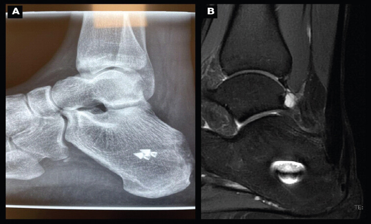 Figure 4: Post-operative imaging of the right foot/ankle. (a) Lateral radiograph at 1 month showing satisfactory position of the calcaneal anchors; (b) Sagittal T2-weighted fat-suppressed (T2 Fat-Sat) Magnetic resonance imaging at 6 months showing a healed insertion.