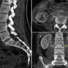 Spinal Epidural Abscess Following Spinal Anesthesia in a Bacteremic Patient: A Case Report