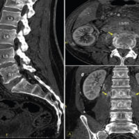 Figure 1: Contrast-enhanced computed tomography of the lumbosacral spine demonstrating irregularity and erosive changes of the L5/S1 vertebral endplates with adjacent paravertebral soft-tissue thickening, consistent with early spondylodiscitis. No definite drainable epidural or paravertebral abscess is identified on computed tomography.