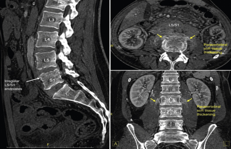 Figure 1: Contrast-enhanced computed tomography of the lumbosacral spine demonstrating irregularity and erosive changes of the L5/S1 vertebral endplates with adjacent paravertebral soft-tissue thickening, consistent with early spondylodiscitis. No definite drainable epidural or paravertebral abscess is identified on computed tomography.