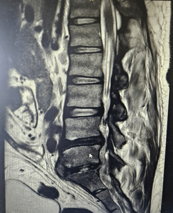 Figure 2: Sagittal magnetic resonance imaging demonstrating extensive lumbar epidural abscess extending from L4 to S1 with associated L5/S1 spondylodiscitis thecal sac compression.