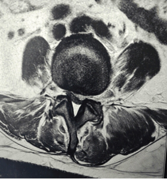 Figure 3: Axial magnetic resonance imaging demonstrating posterior epidural collection causing compression of the thecal sac at the lumbosacral level.