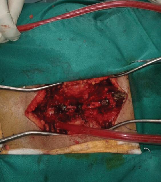 Figure 4: Intraoperative image following lumbar laminectomy demonstrating epidural purulent collection and inflammatory tissue within the lumbosacral space.